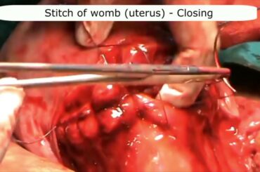 Cesarean section (C-section) / cesarean delivery step by step Video presentation