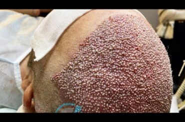 BEST HAIR TRANSPLANT TURKEY | Nicolò from Italy🇮🇹 | FUE SAPPHIRE