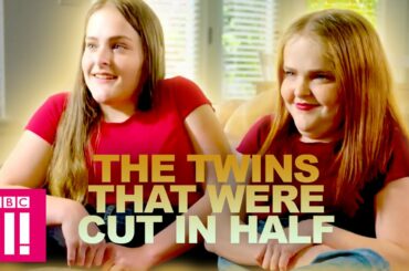 The Twins That Were Cut In Half | Living Differently