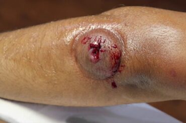 Cupping (Hijama) Therapy After WORM Comes Out From Insect Bite!